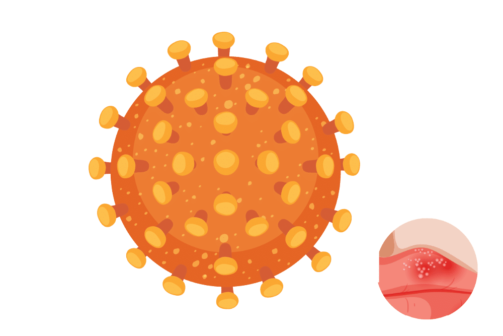 Illustration eines Herpesvirus und typischer Bläschen an der Haut