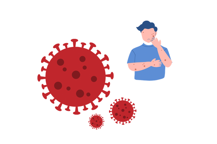 Illustration zu Mpox mit Virusdarstellung und einer Person mit Hautveränderungen